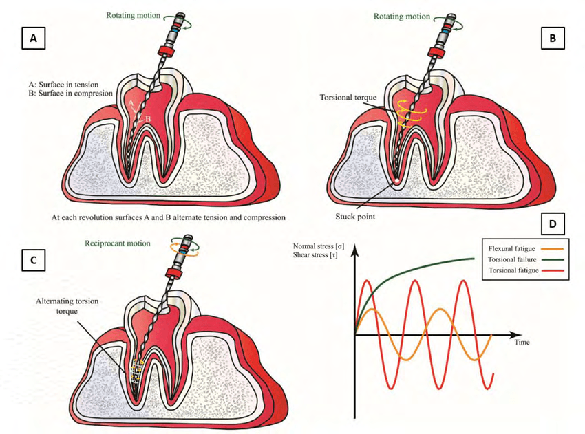 Failure-mechanisms-for-NiTi-endodontic-files-Source-by-authors.png
