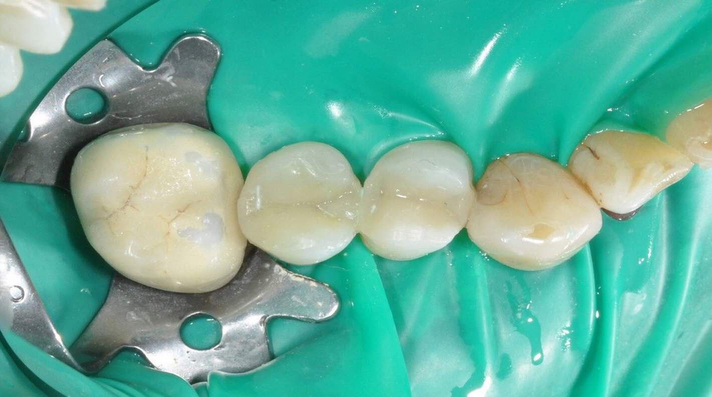 the-importance-of-clamps-isolation-dental-clinic-dental_0.jpeg